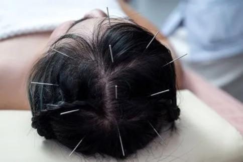 scalp acupuncture is a special kind of acupuncture technique